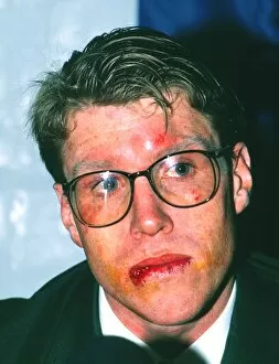 Rugby Collection: Australia captain Nick Farr-Jones shows his battle scars after the 3rd Test - 1989 British Lions
